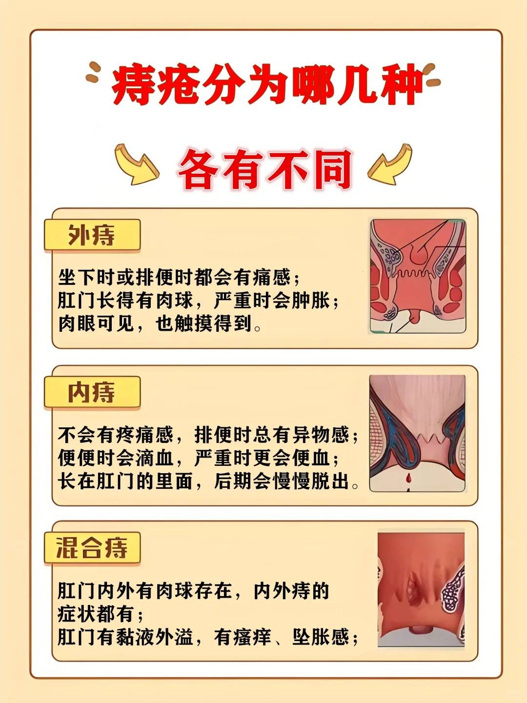 痔疮可以吃鸡蛋吗?