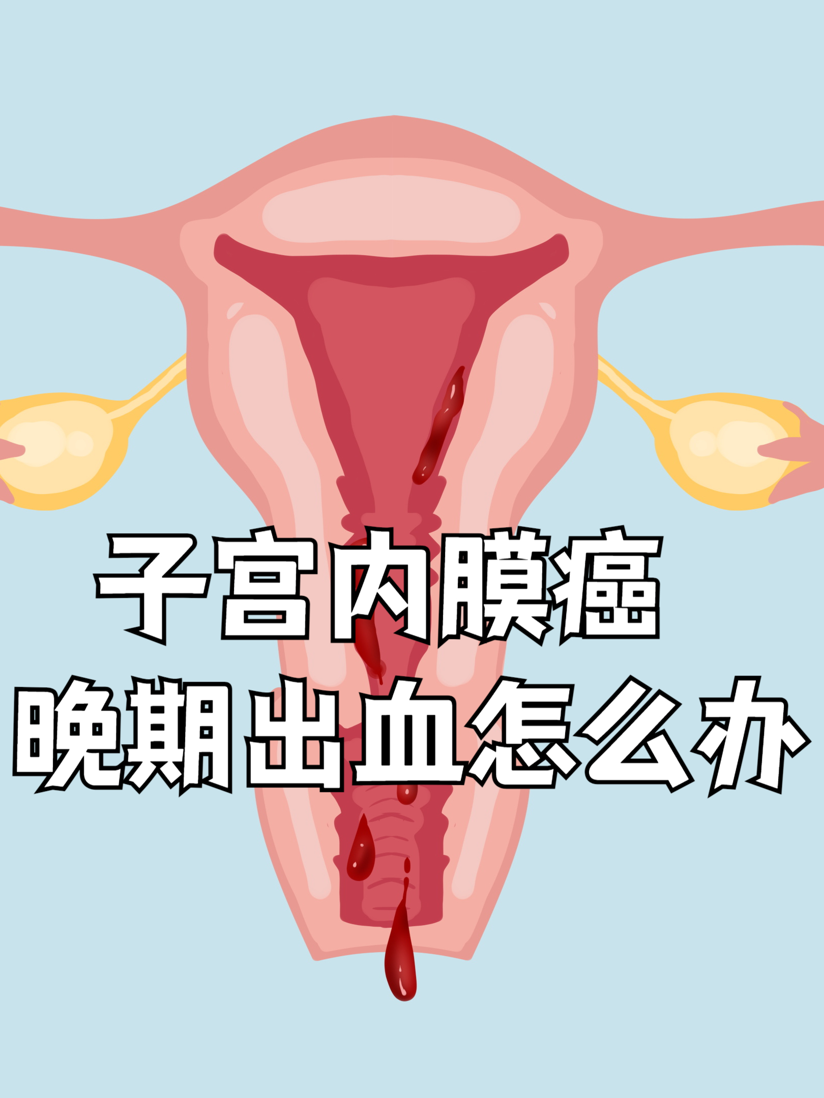 宫颈癌出血的状况和颜色