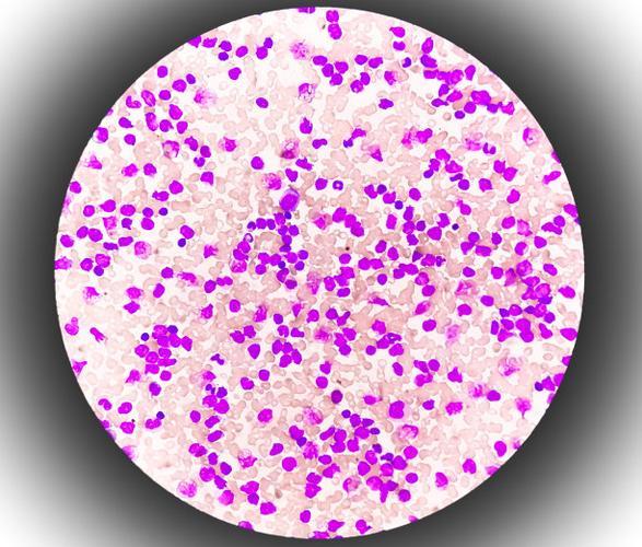 慢性淋巴细胞白血病能活多久?