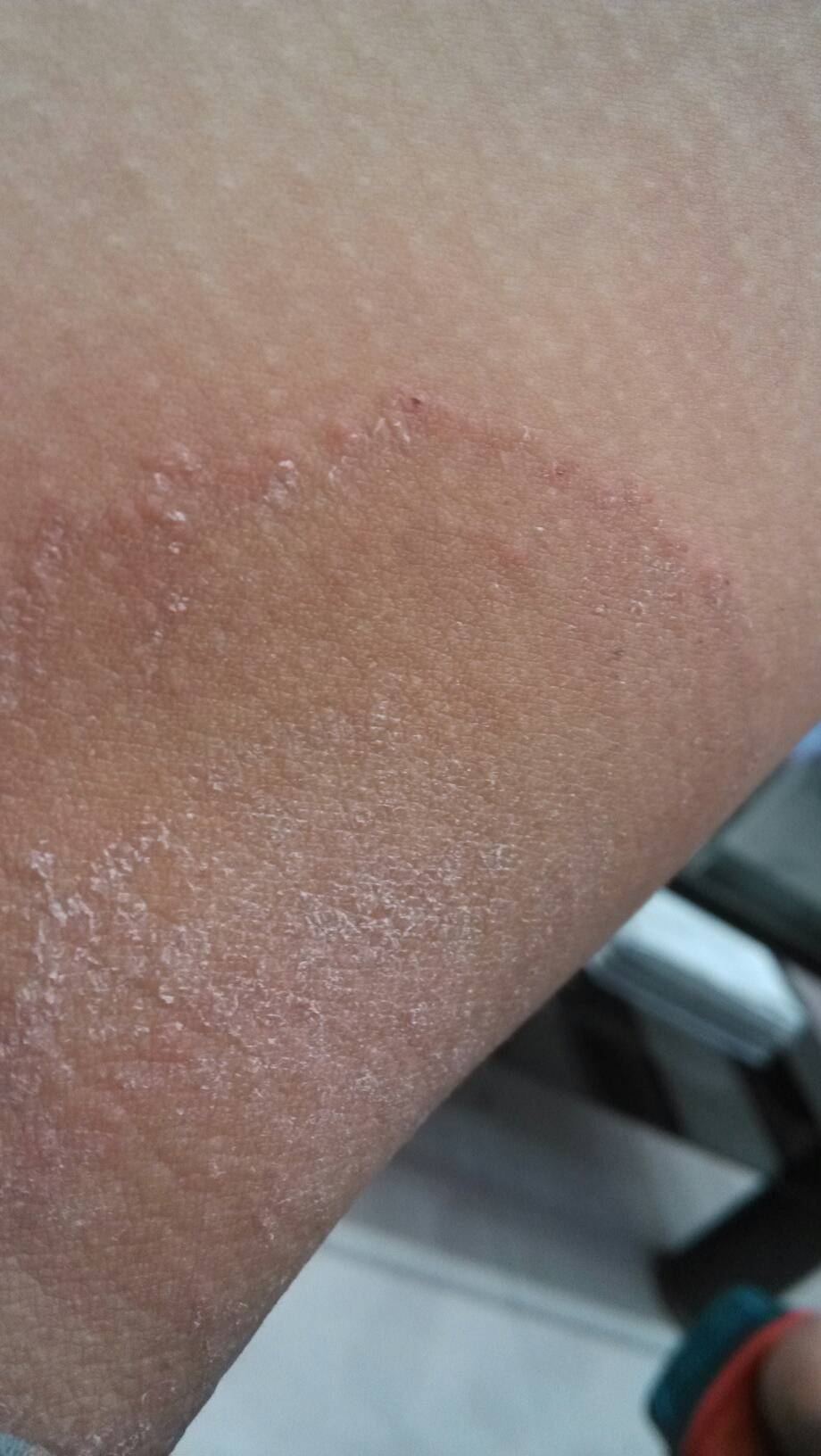 大腿内侧有红斑不疼不痒