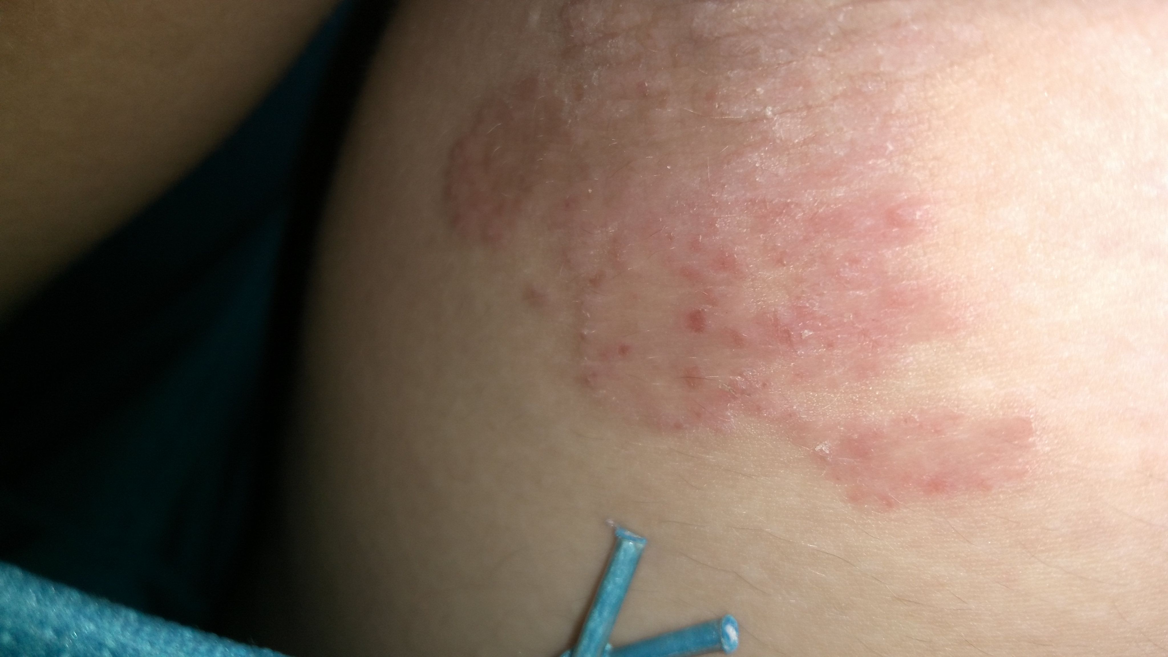 大腿内侧有红斑不疼不痒