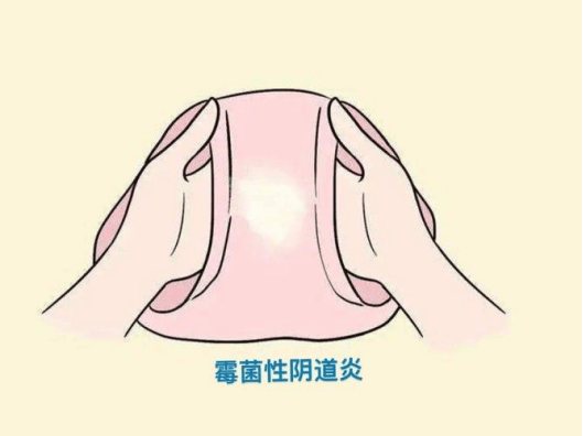 阴道炎哪些症状