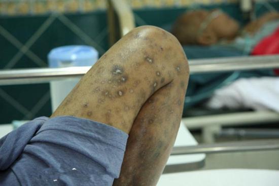 男性艾滋病初期症状?