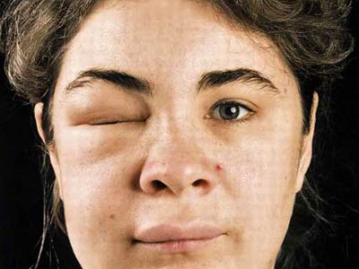 血管神经性水肿有哪些症状?