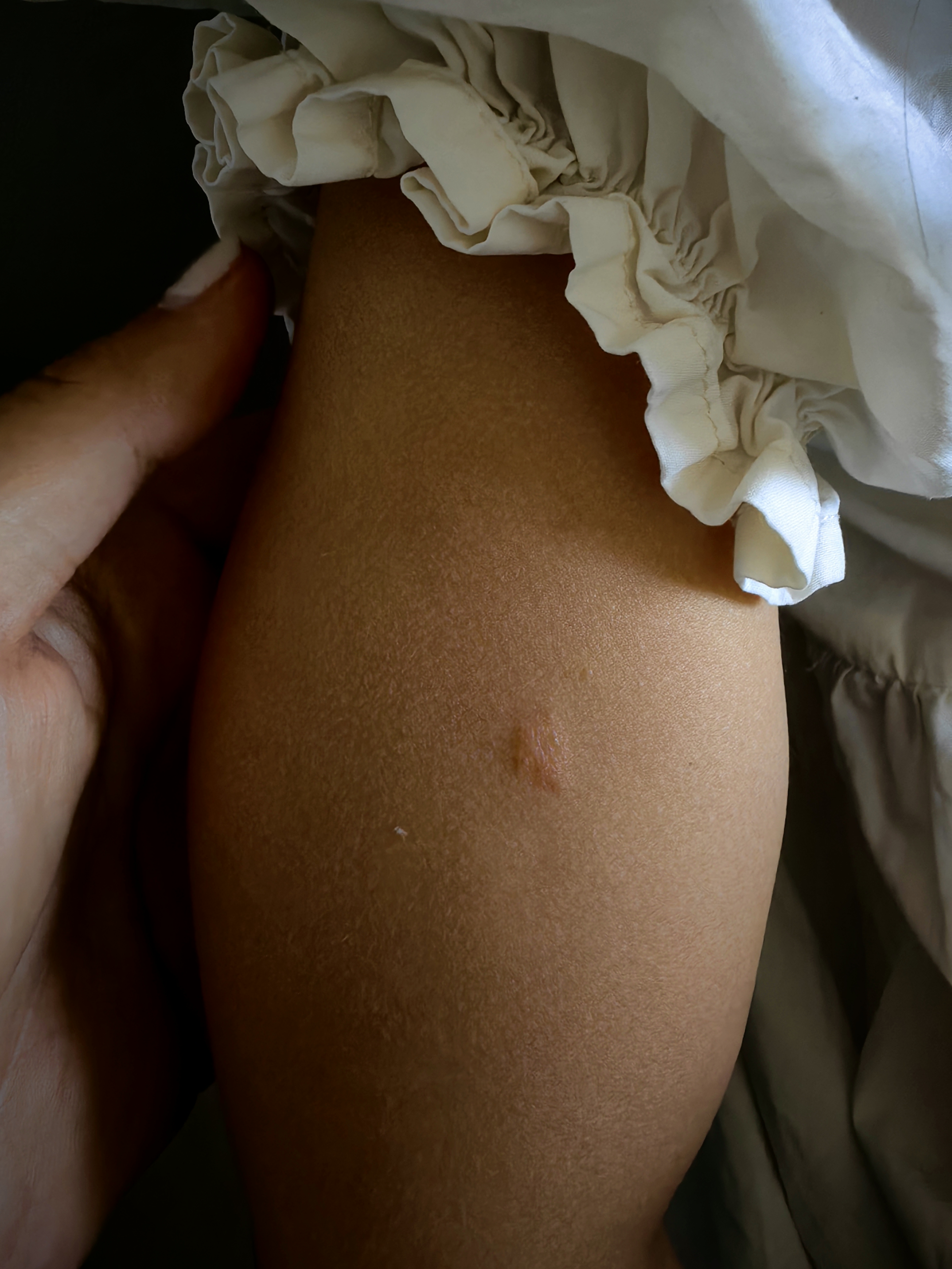 胳膊上有小疙瘩能挤出来白色的东西