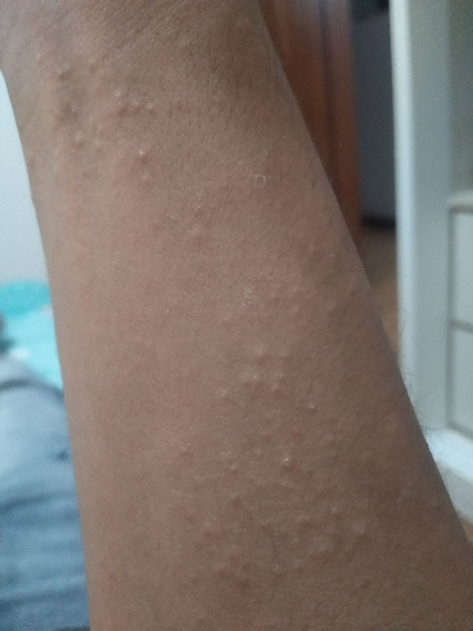 胳膊上有小疙瘩能挤出来白色的东西