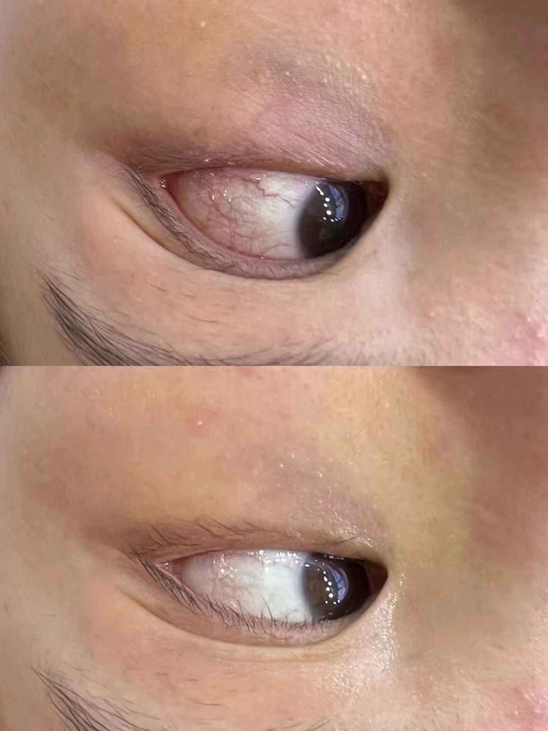 眼睛浑浊有点发黄该怎么办