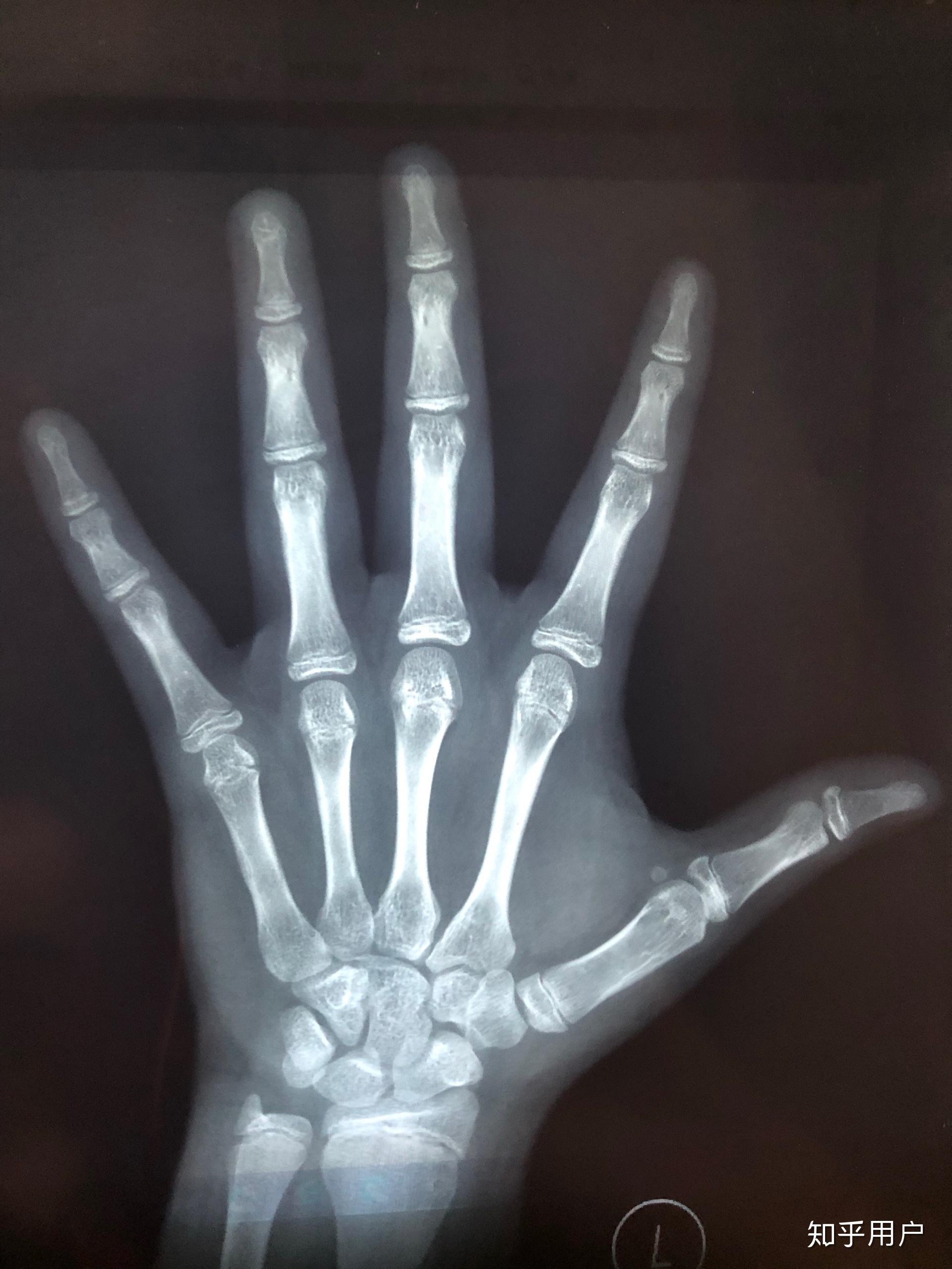 骨骼线闭合检查挂什么科?