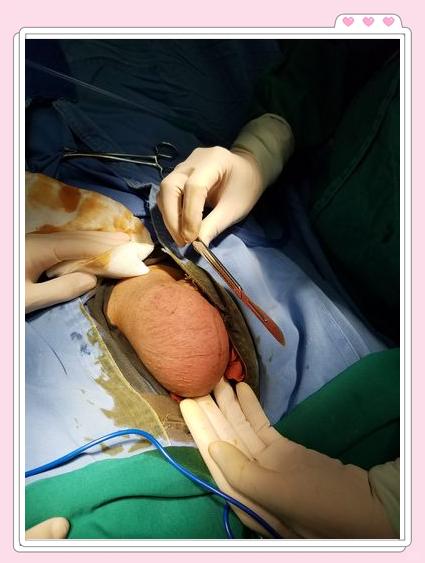 小孩鞘膜积液怎么治