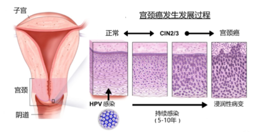 宫颈筛查是检查多少钱