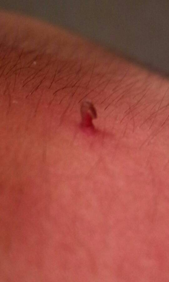 身上有红色的小血点是怎么回事