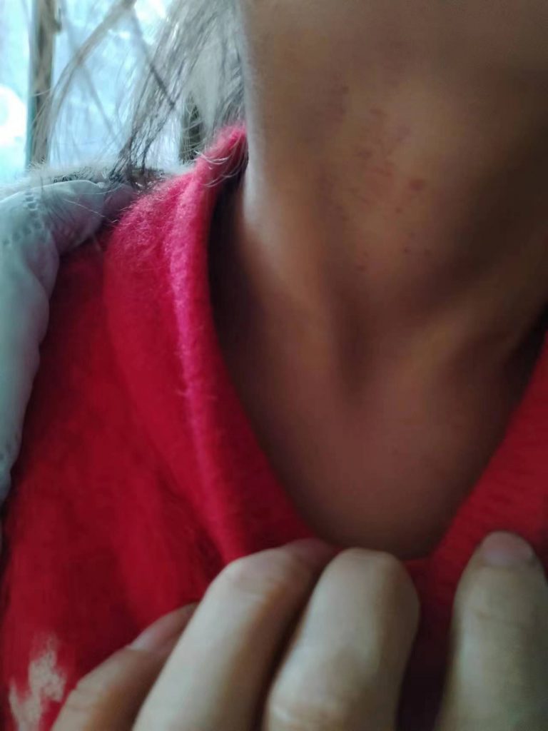 身上有红色的小血点是怎么回事