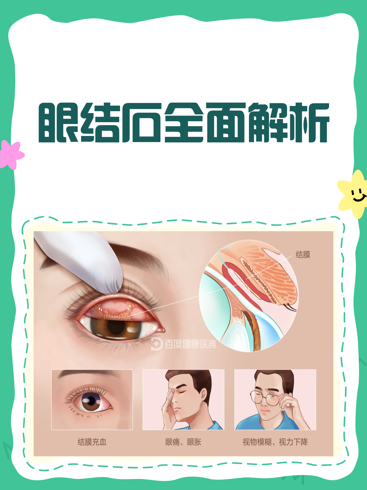 眼结石是怎么回事?