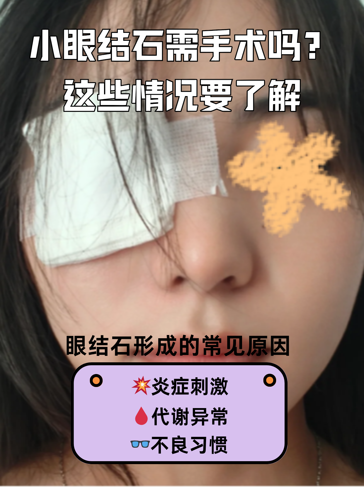 眼结石是怎么回事?