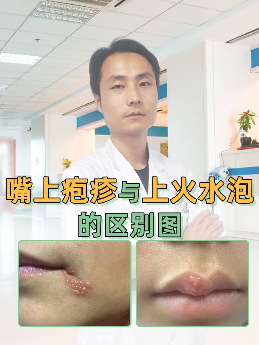 嘴唇上起了很多小水泡