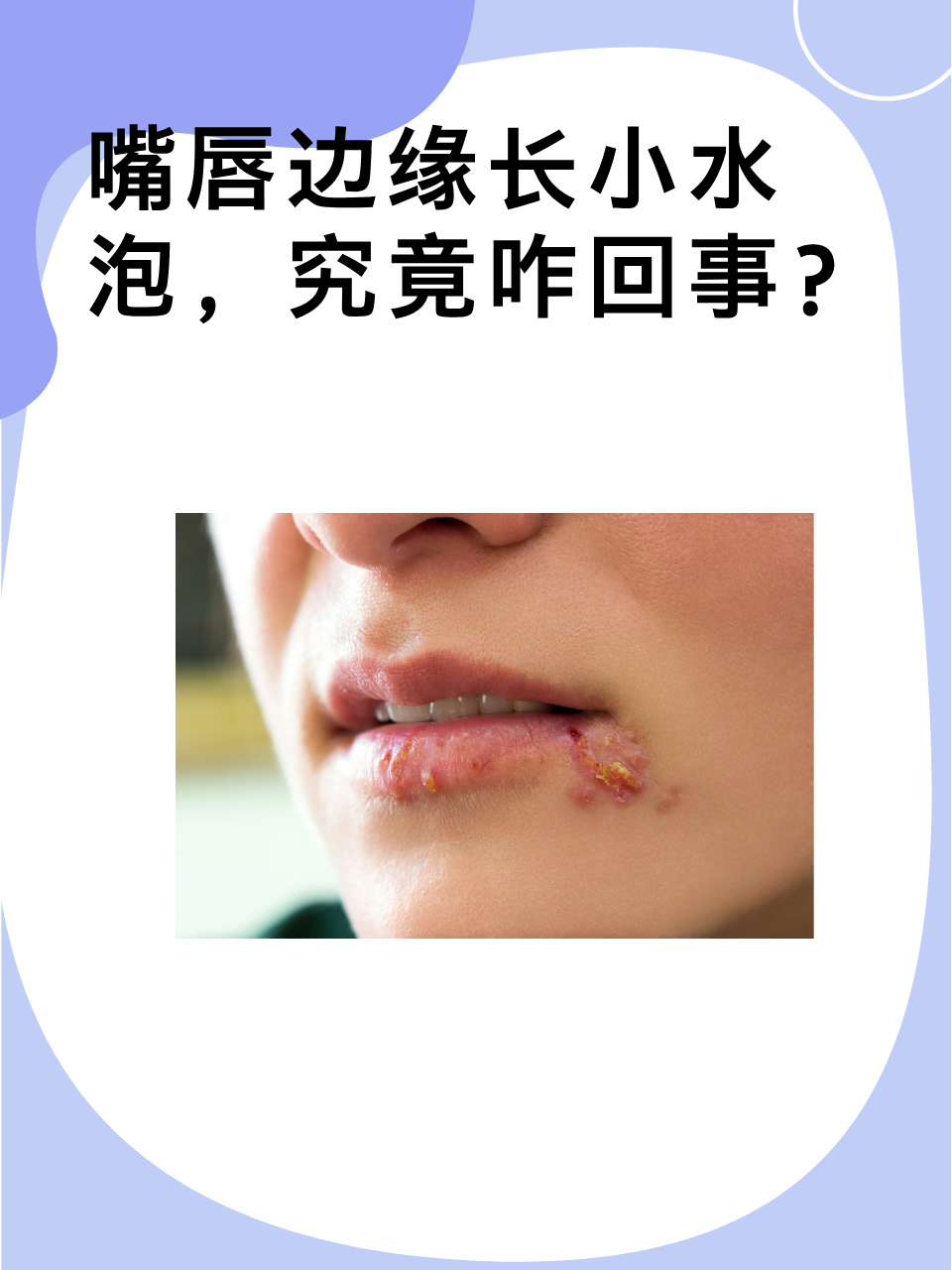嘴唇上起了很多小水泡