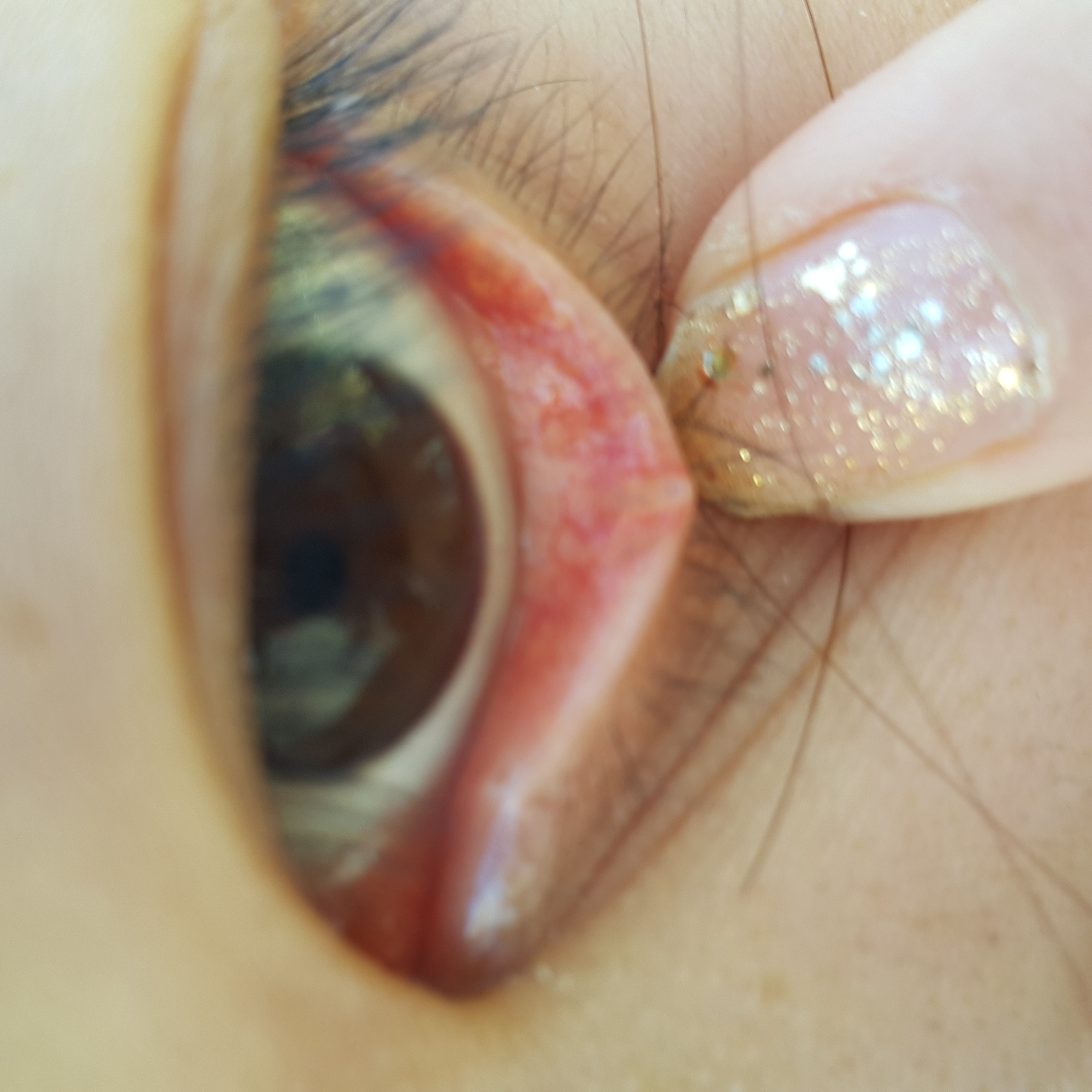 下眼皮里面长了个小疙瘩