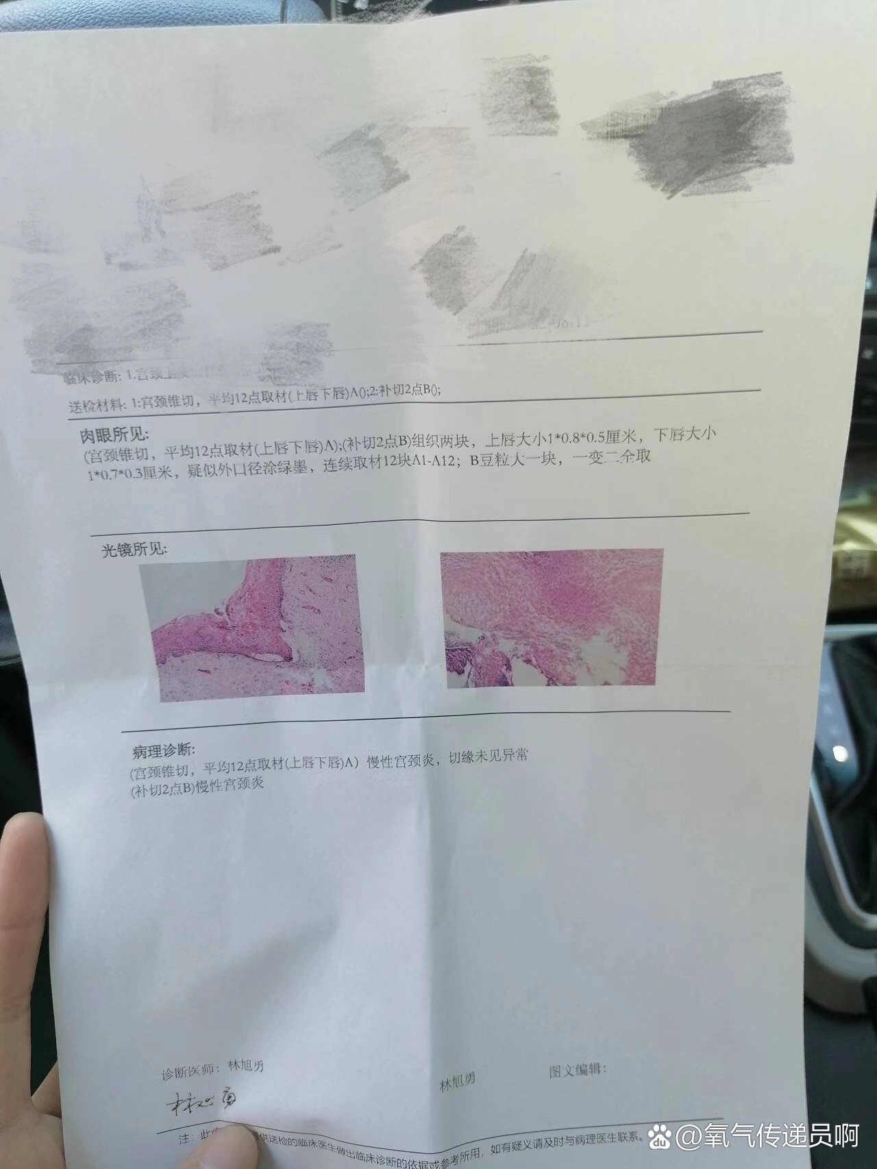 刚刚做完LEEP刀宫颈修复手术好后悔