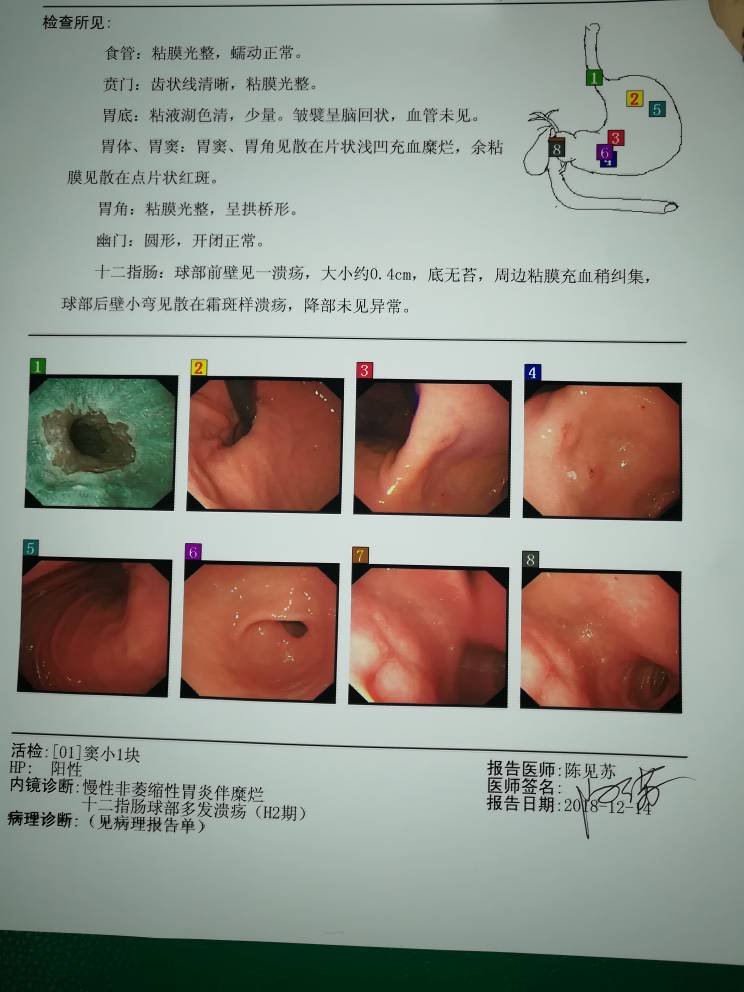 非萎缩性胃炎伴糜烂是什么意思?