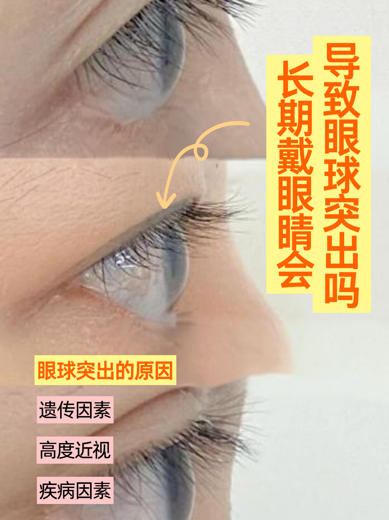 近视眼睛突出怎么恢复?