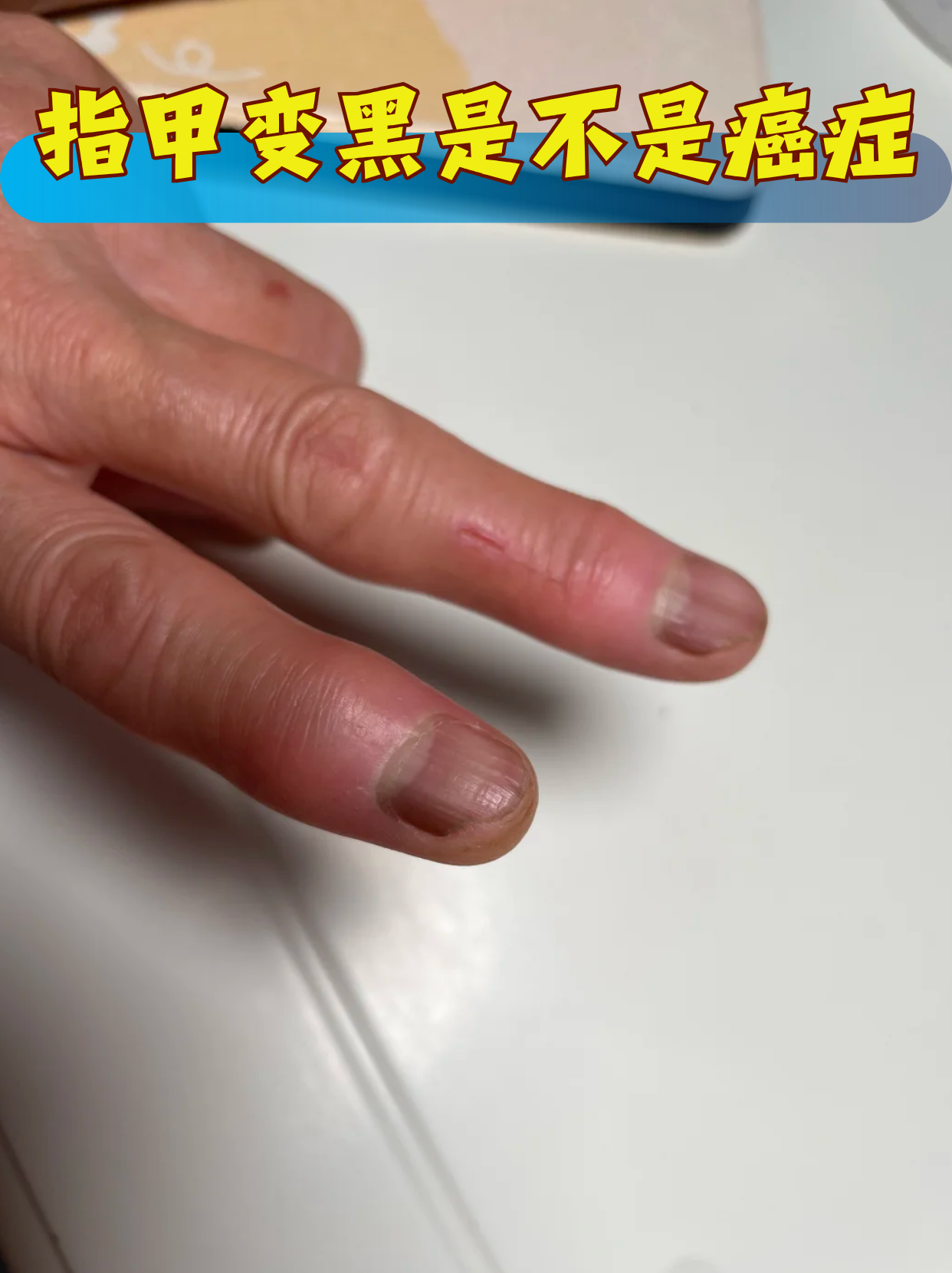 指甲盖上有黑线,是癌症吗