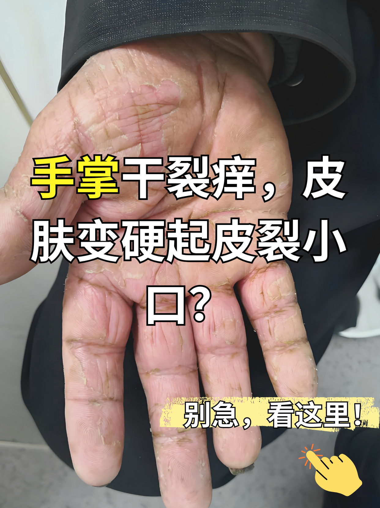 手部湿疹和手癣的区别