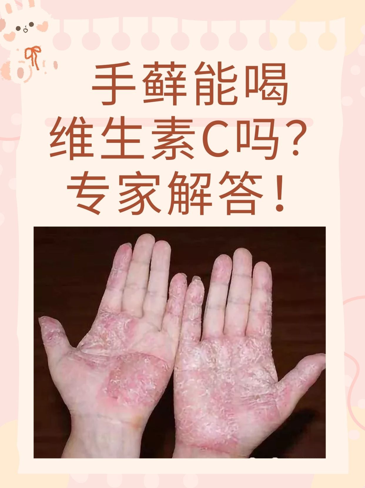 手部湿疹和手癣的区别