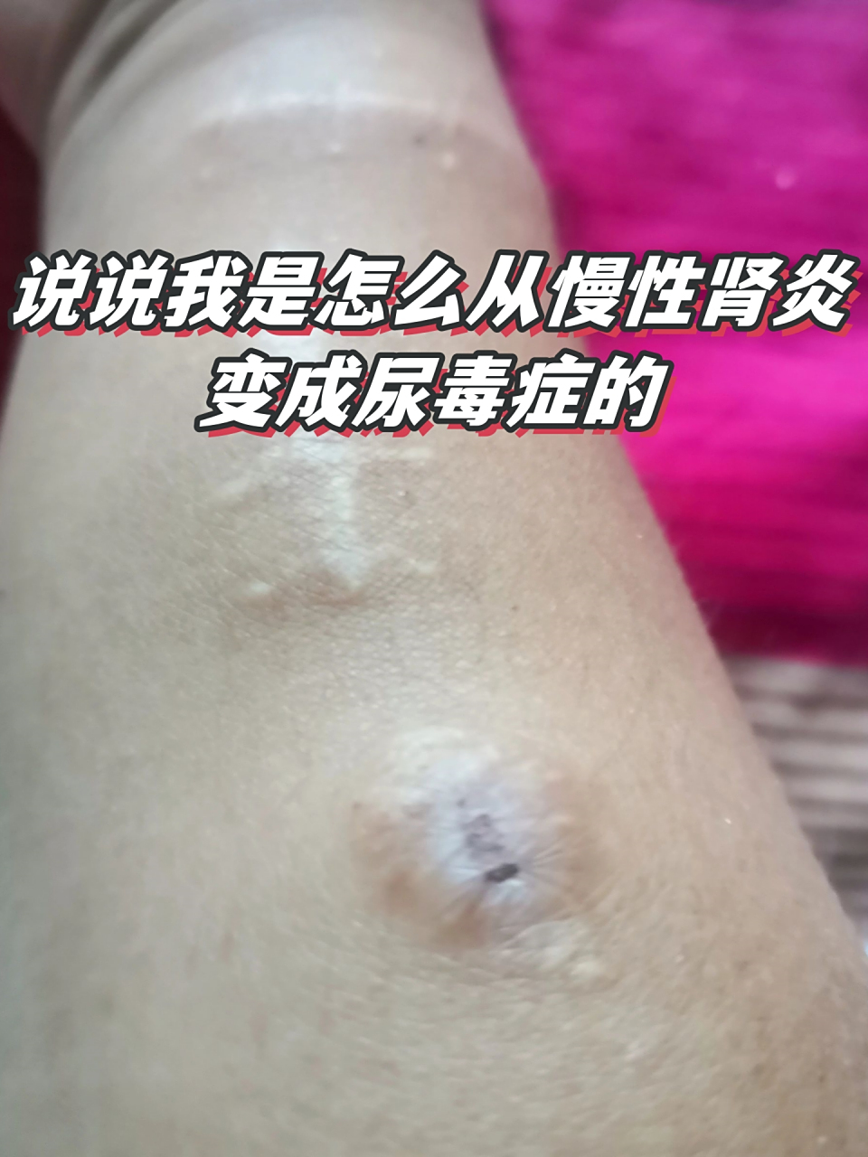 慢性肾炎有啥症状