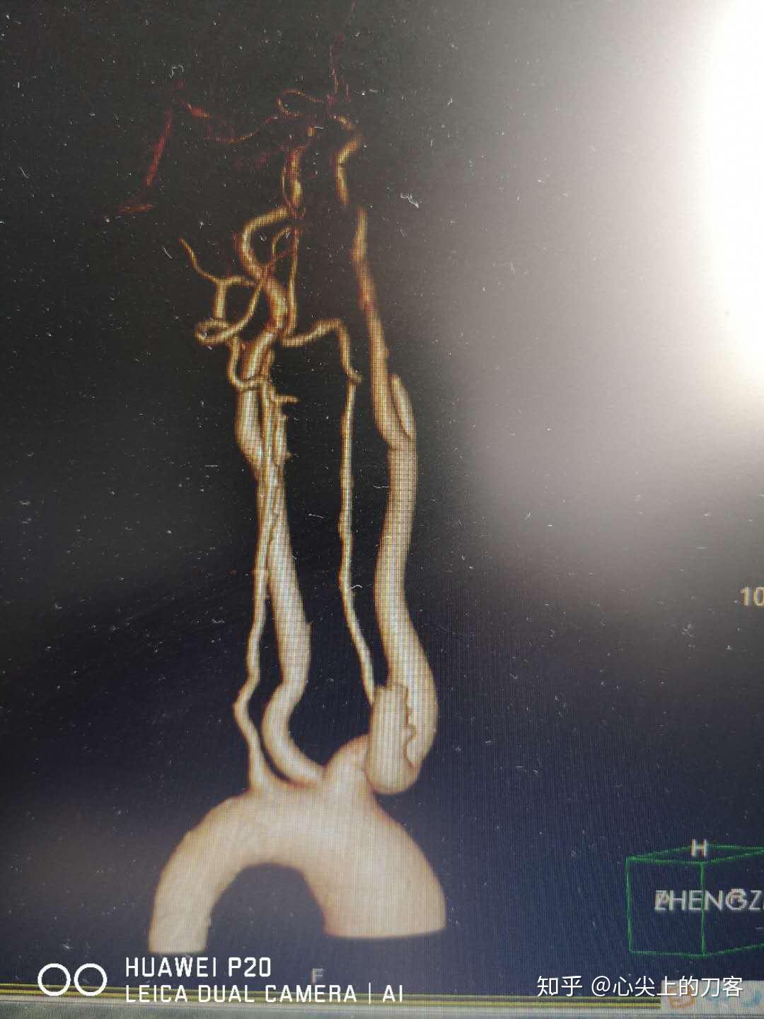 多发性大动脉炎