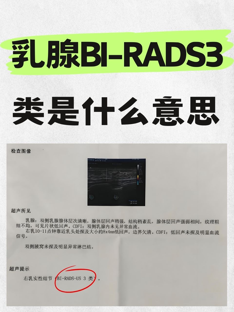 乳腺癌三阴性是什么