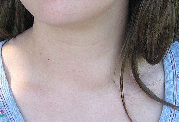 甲亢有什么症状表现?