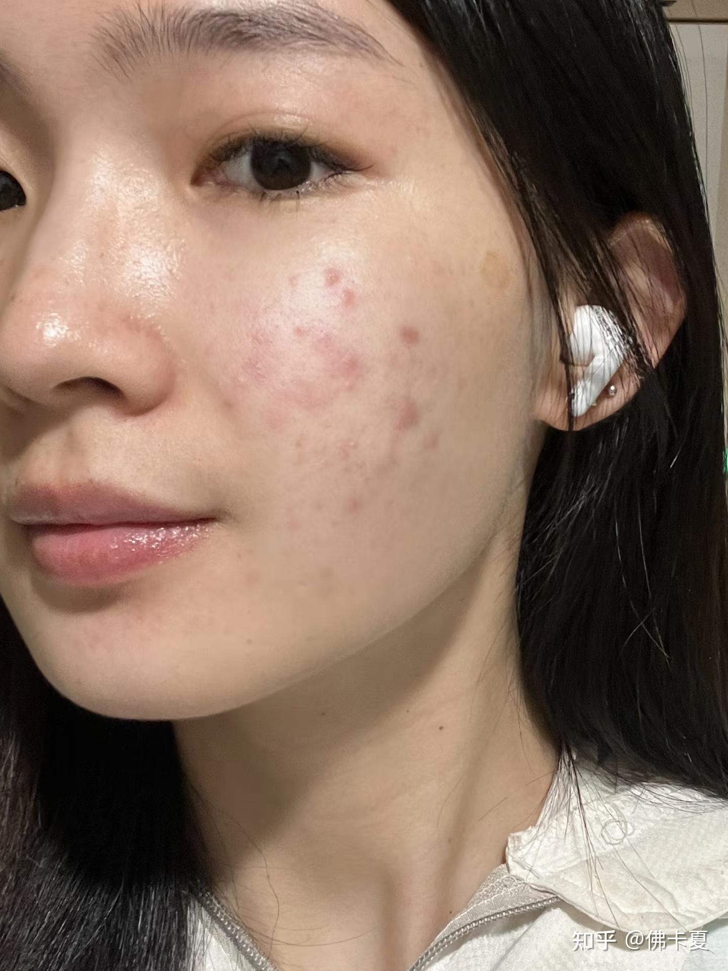 痘坑痘印,这种皮肤质量