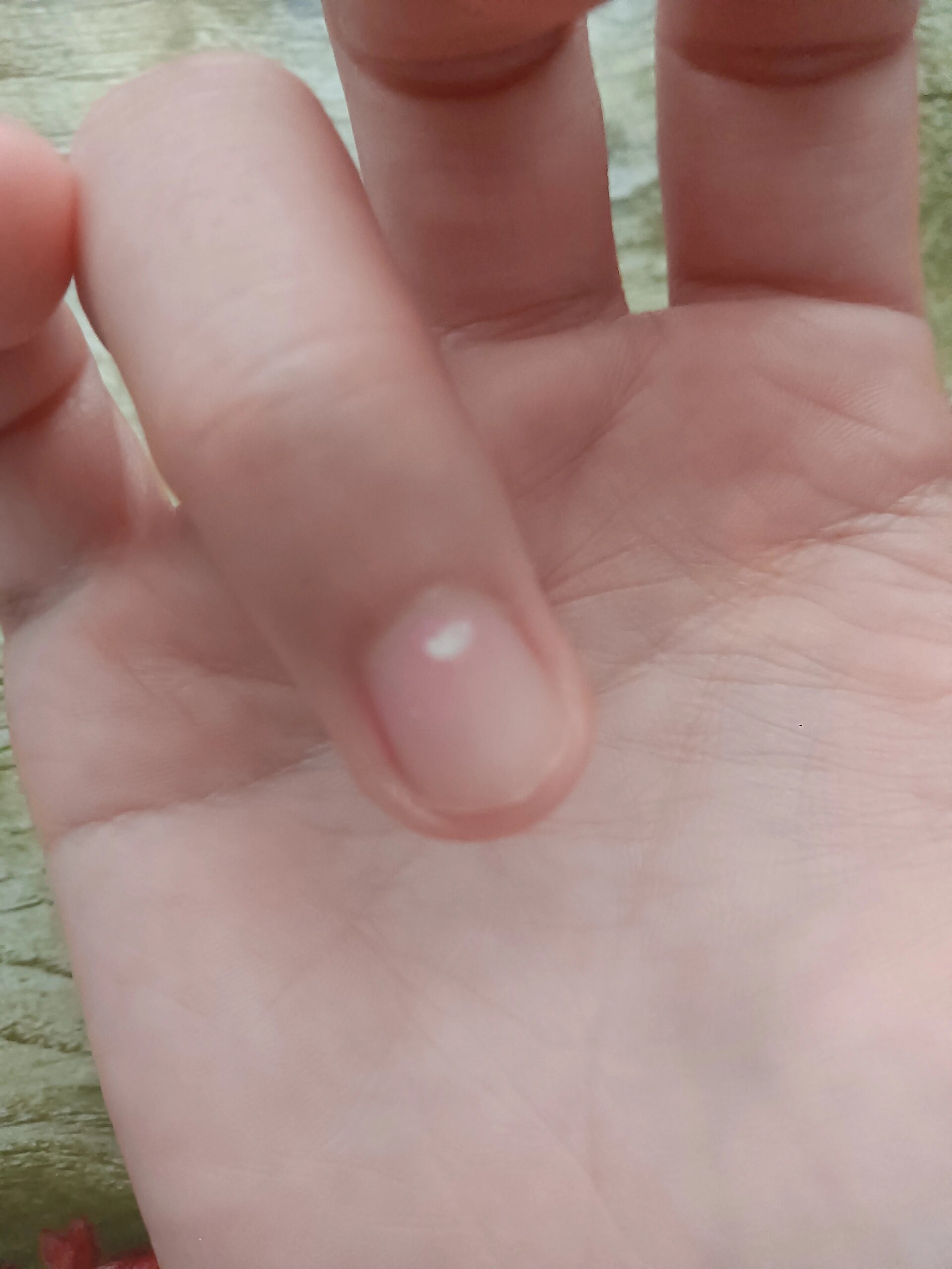 手指甲上有小白点