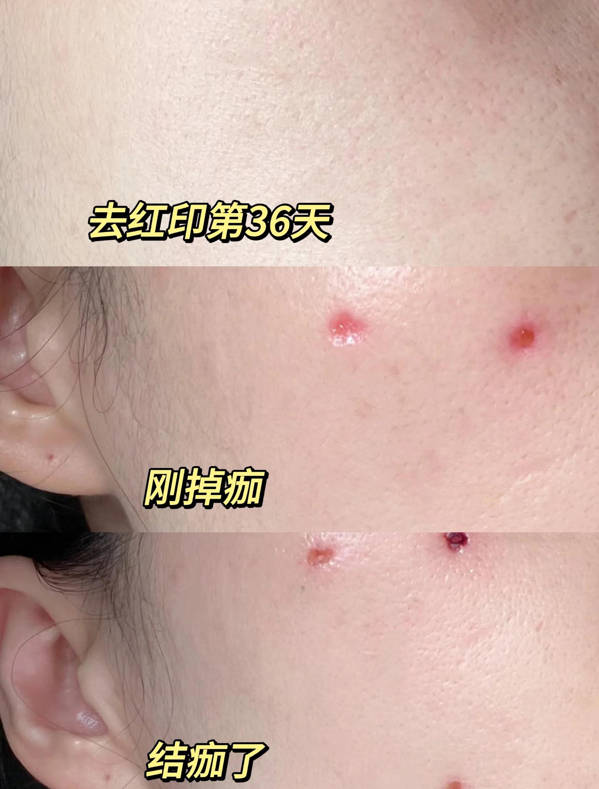 点痣要多久才能恢复正常