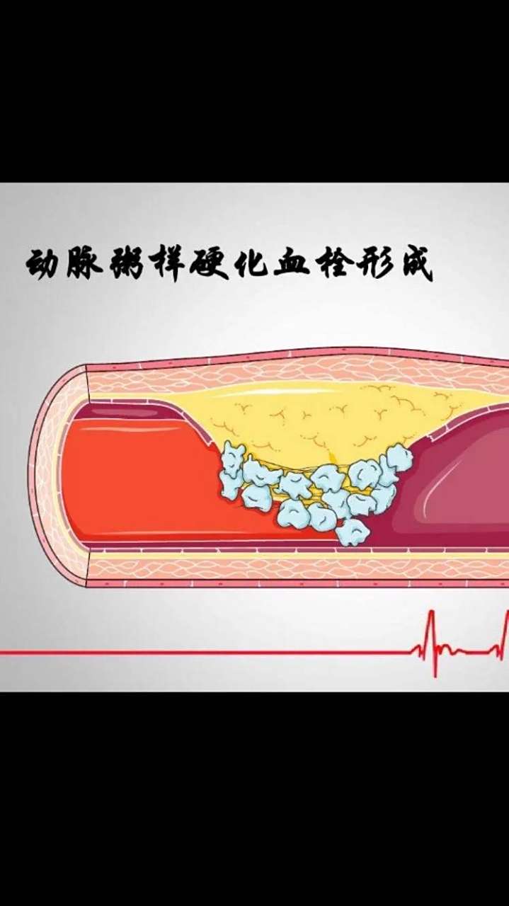 冠状动脉粥样硬化