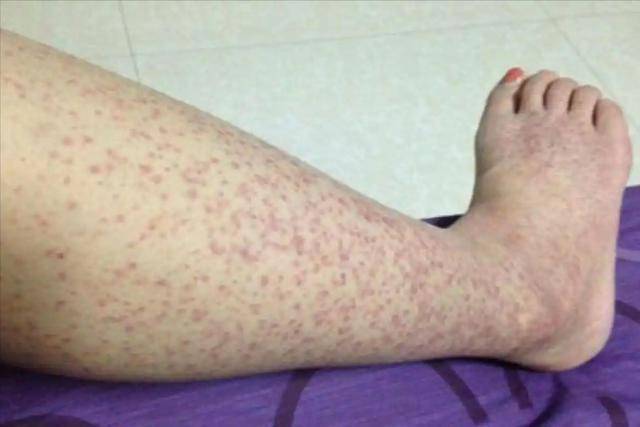 肾衰竭的早期症状