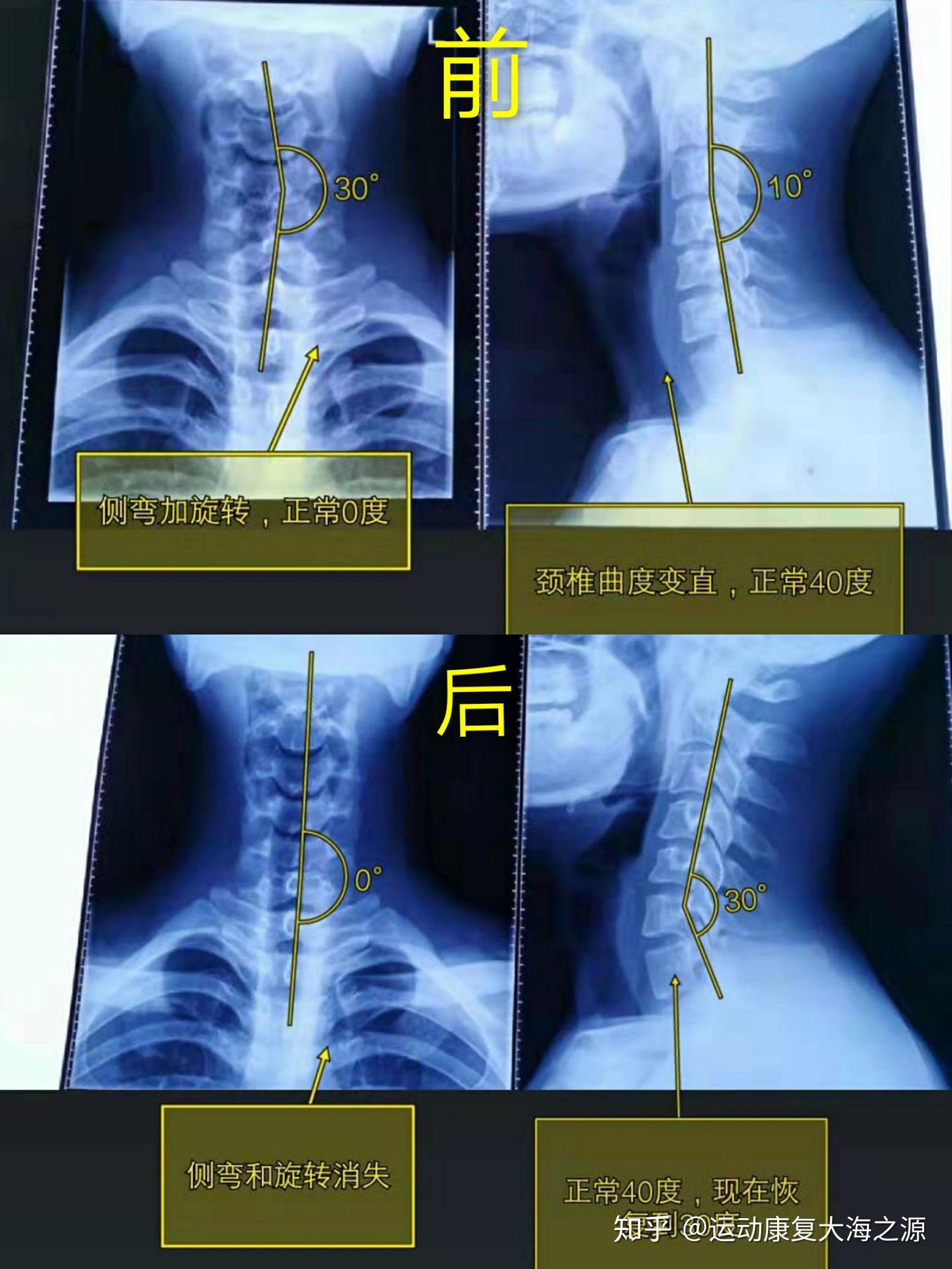 寰枢关节半脱位严重吗