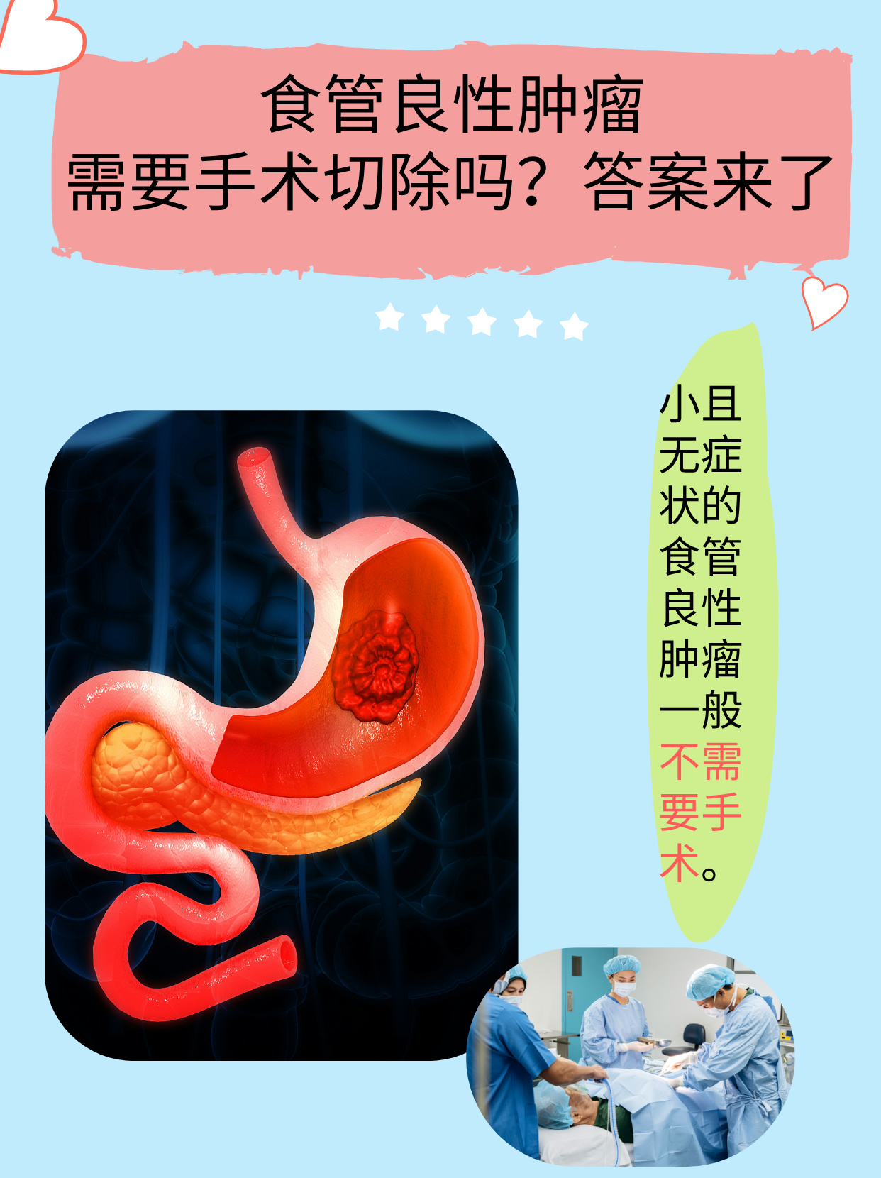 食道癌传染吗?