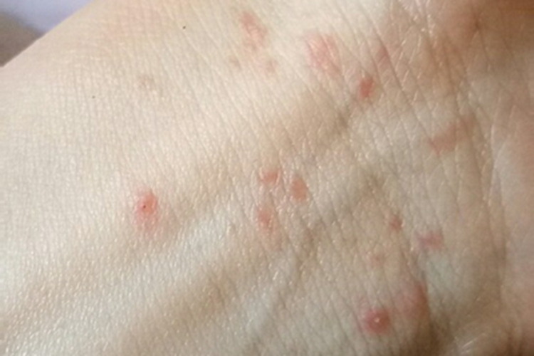身上起小红点是艾滋病吗