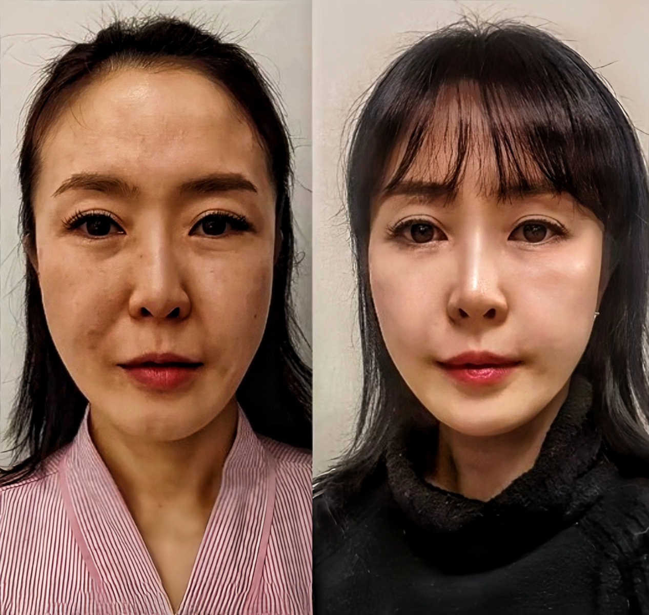 线雕提升有危害吗