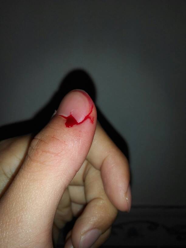 请问医生仓鼠咬人三天后死了,这个要紧吗?