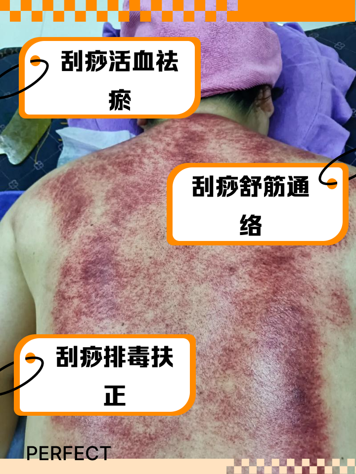 经常刮痧对身体好吗