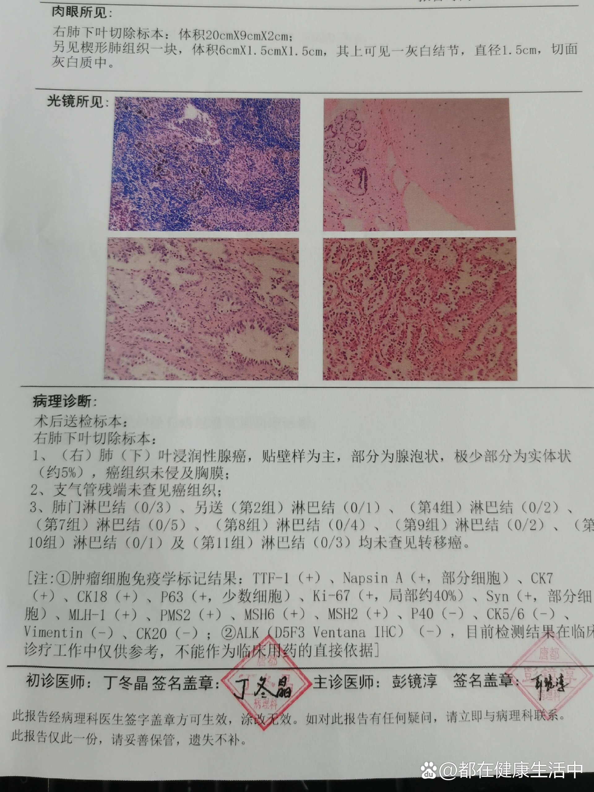 肺腺癌早期能治愈吗