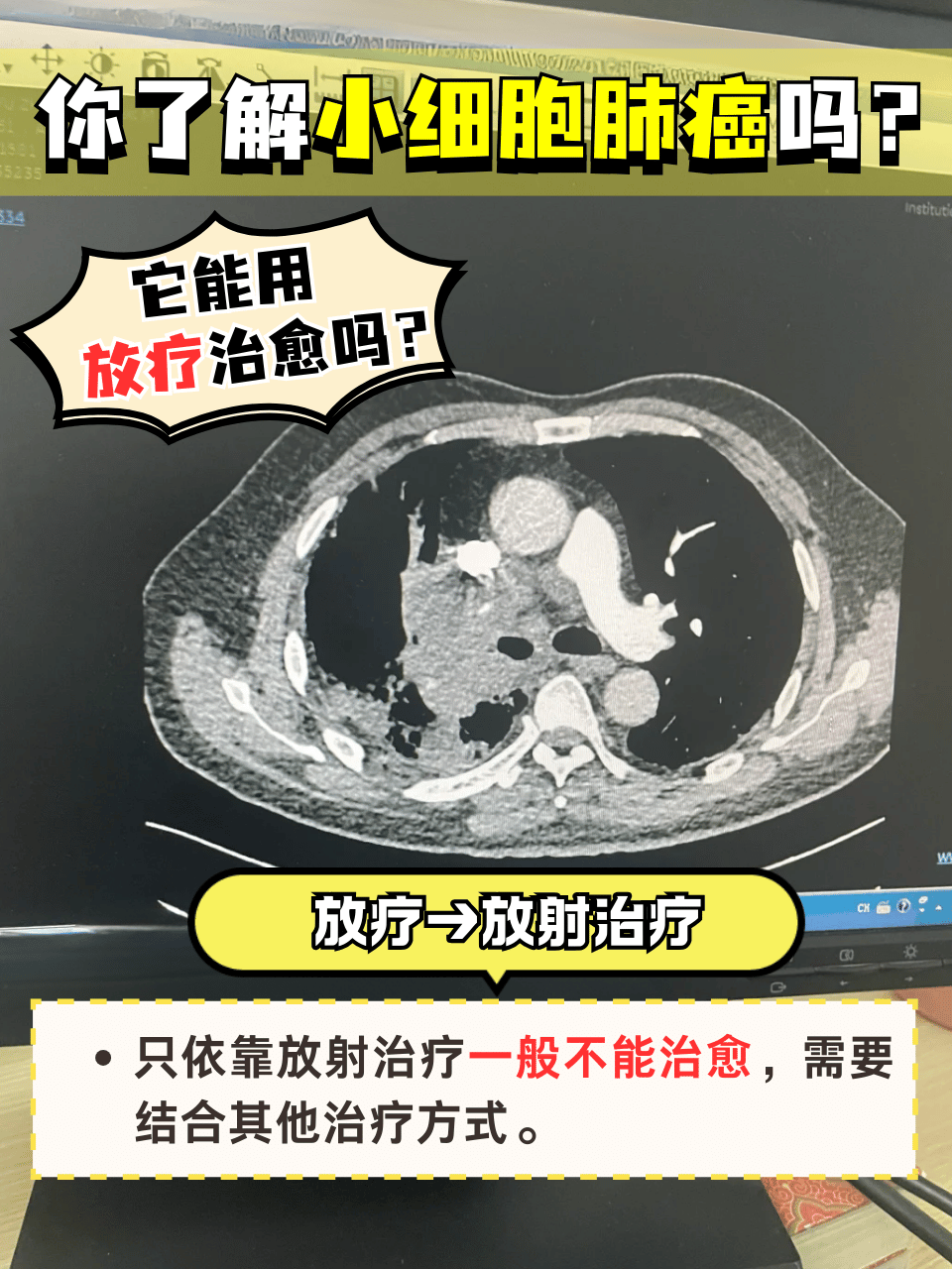 肺腺癌早期能治愈吗