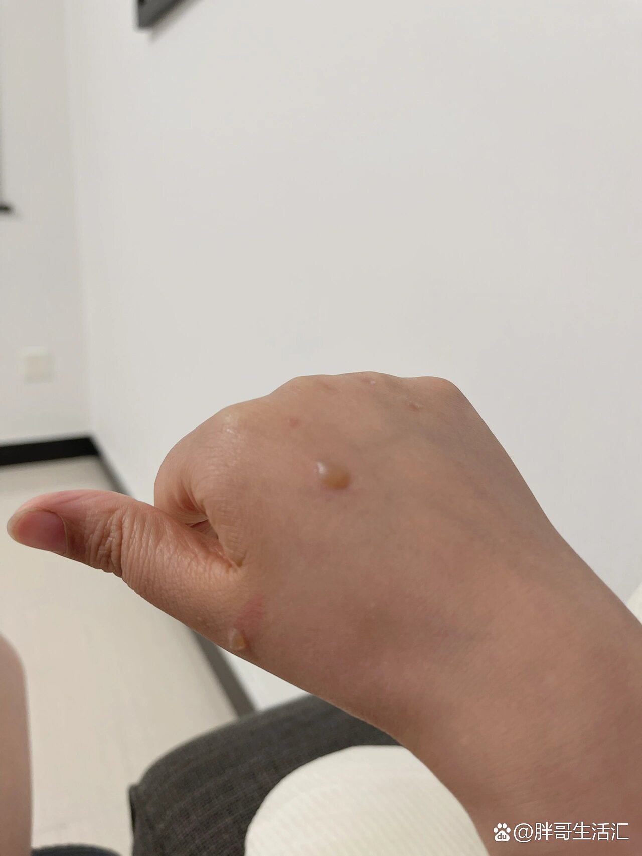 烫伤的水泡要挑破吗?