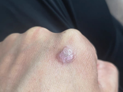 手背上长了个硬疙瘩