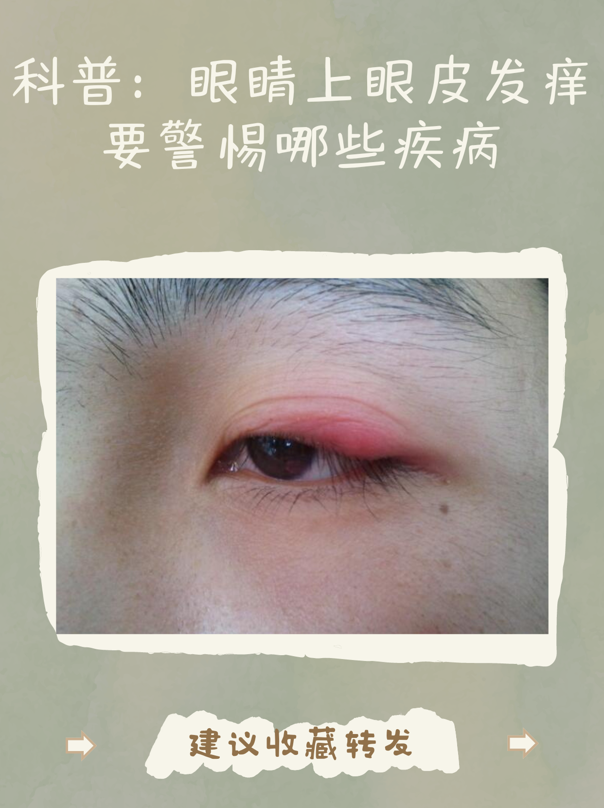 眼角痒是怎么回事?