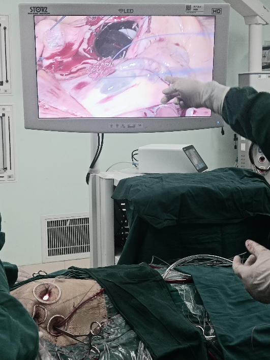 主动脉瓣置换术