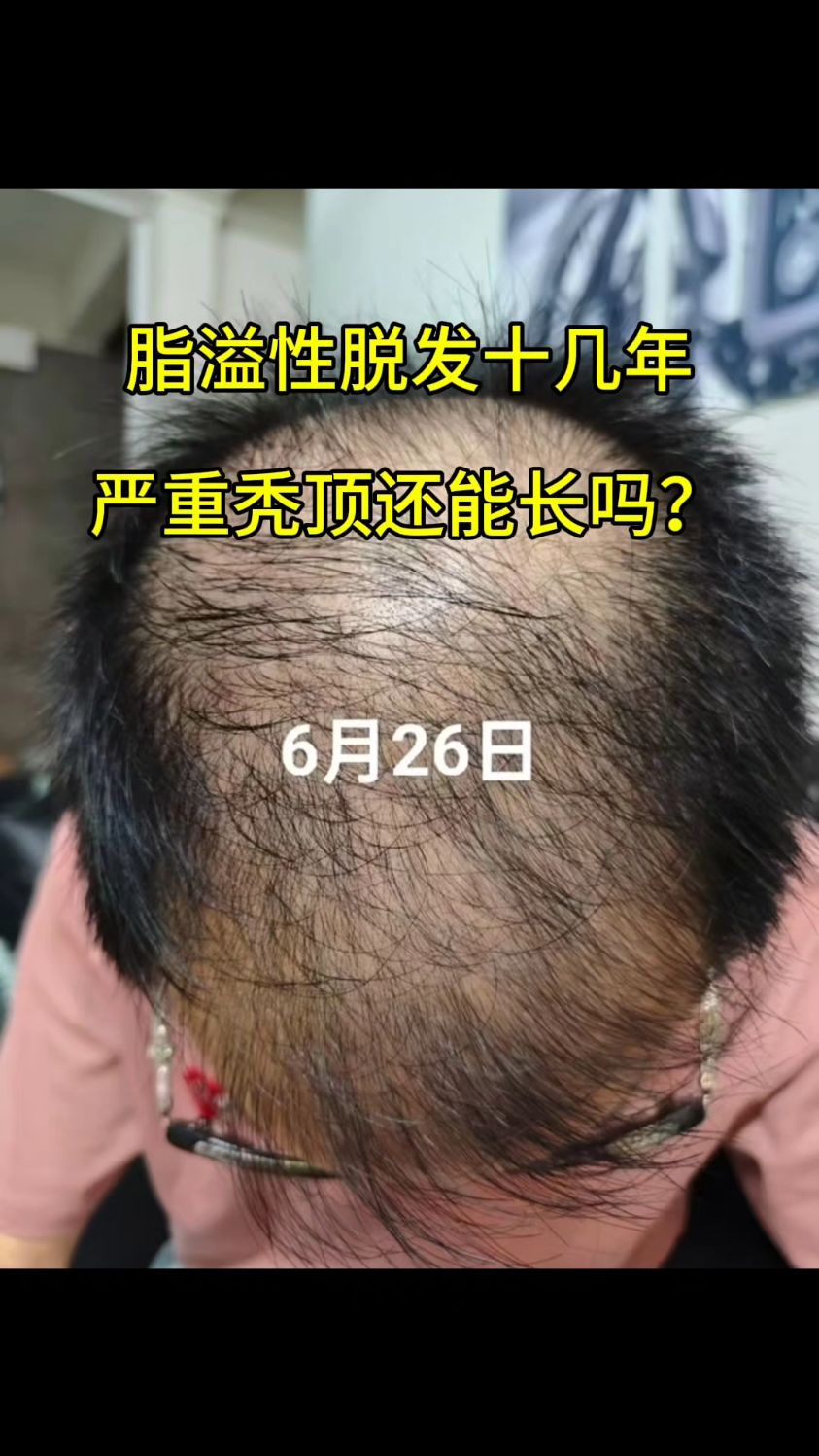 脂溢性脱发是不是治不好?