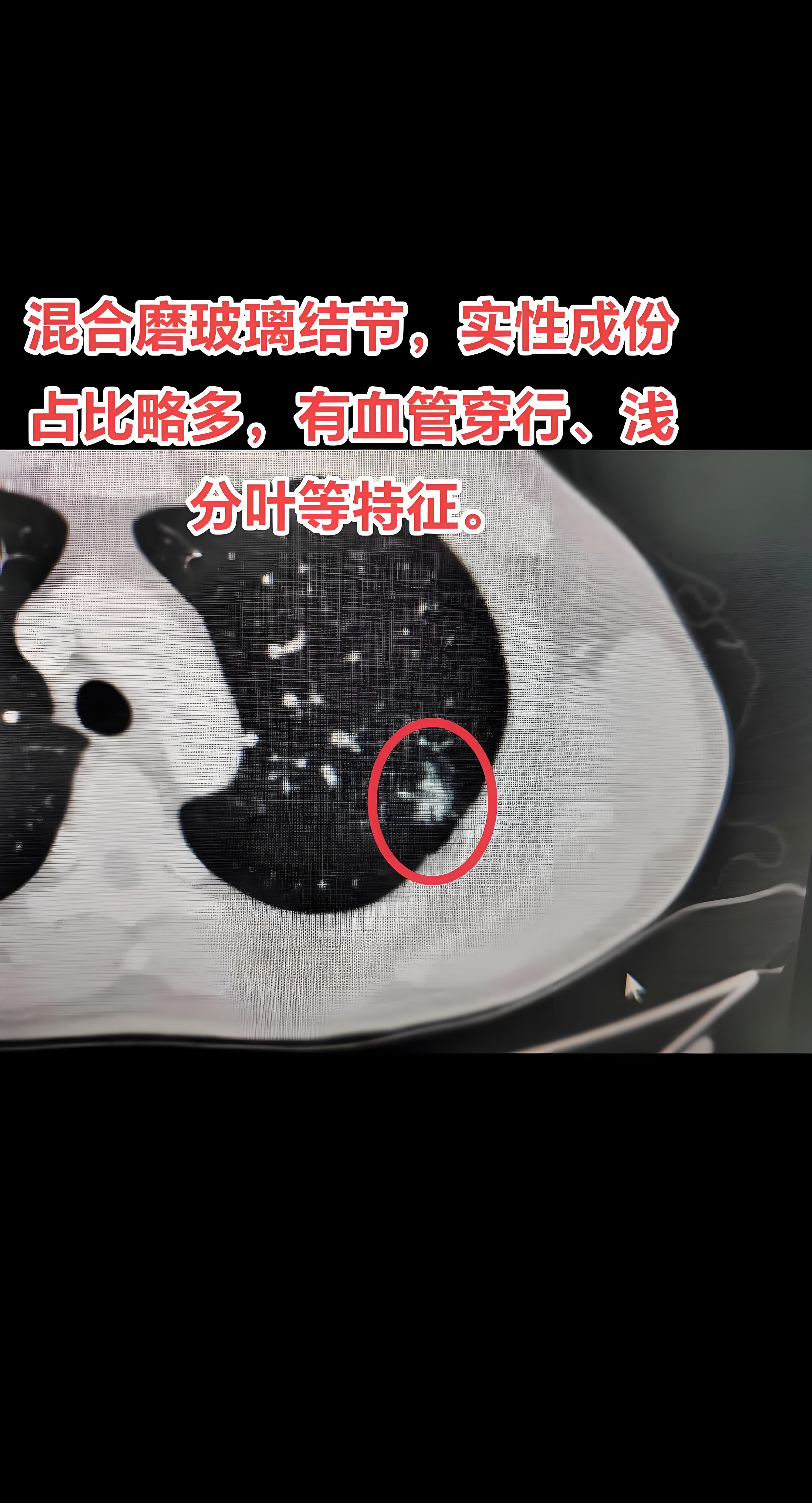 肺部磨玻璃结节是怎么回事